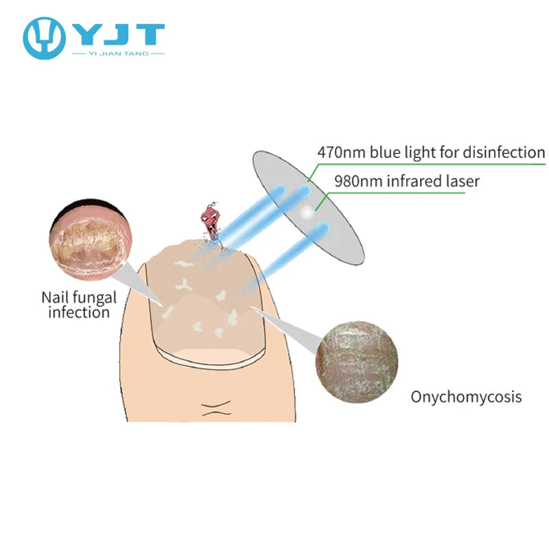 Antifungal Cold Laser Device Nail Fungus Treatment Device