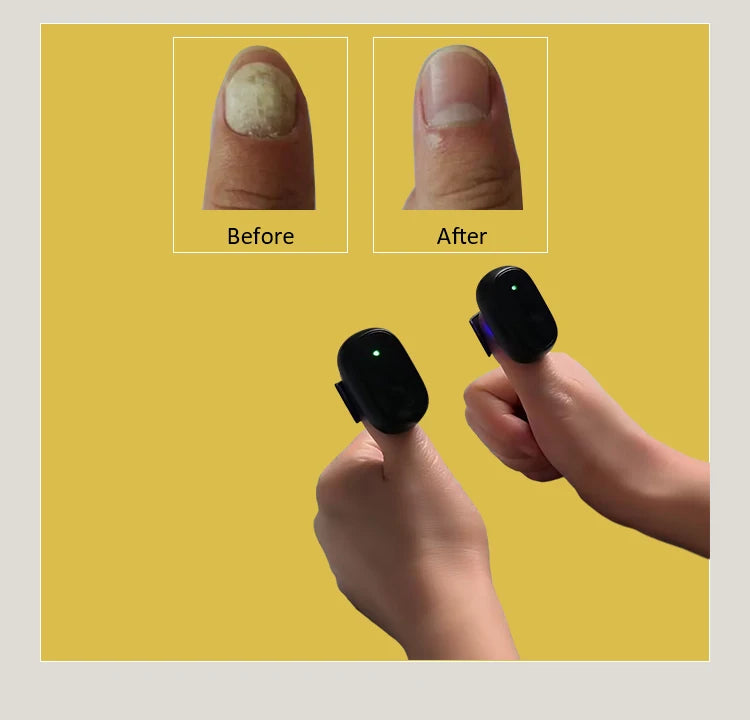 Antifungal Cold Laser Device Nail Fungus Treatment Device