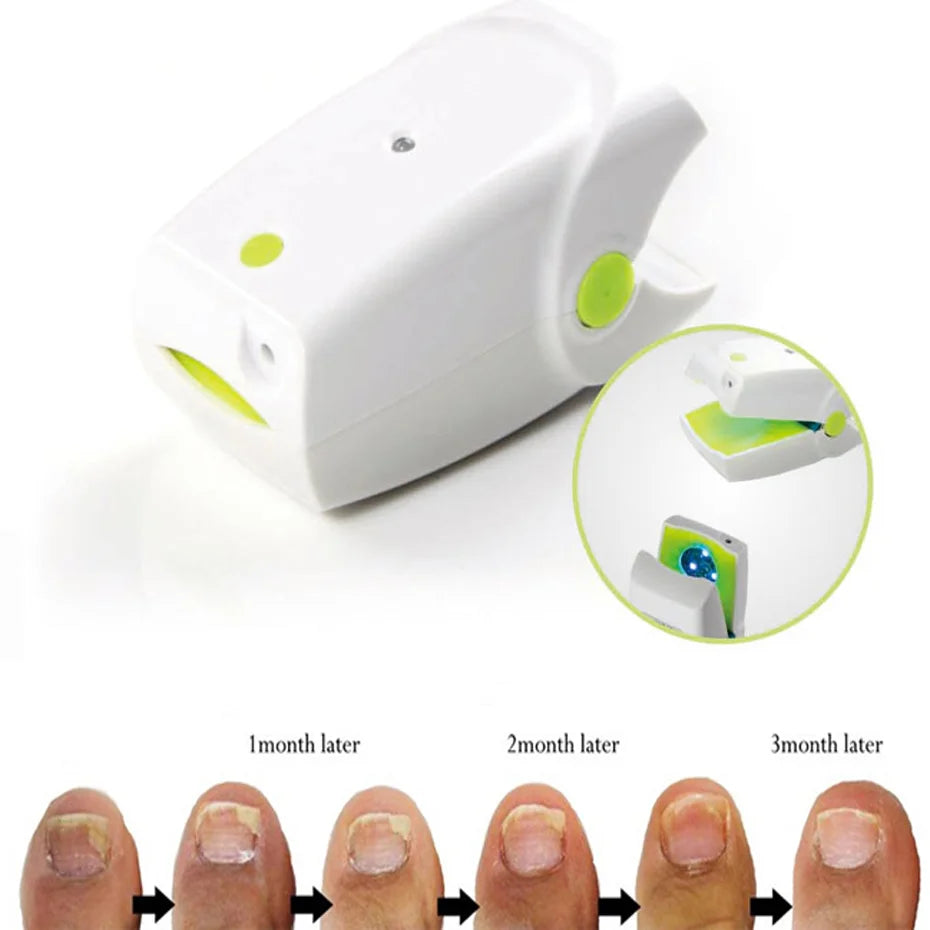 Fungal Nail Infections Laser Therapy Device for Foot Care