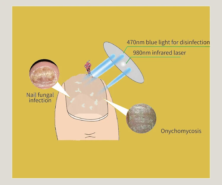 Antifungal Cold Laser Device Nail Fungus Treatment Device